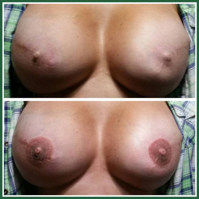 Breast cancer, Breast re-pimentation, areola 